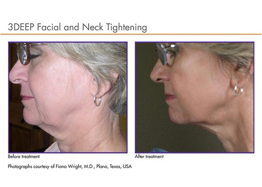 face skin tightening treatment