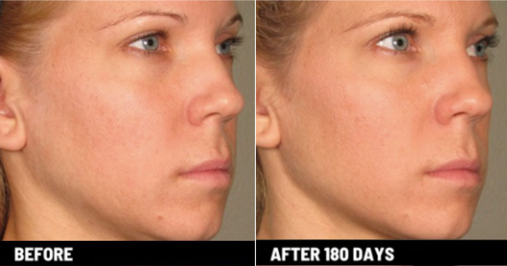 ultherapy treatment after & Before